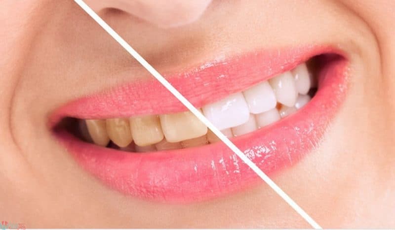 16 وصفة طبيعية لتبييض الاسنان بسرعة في المنزل