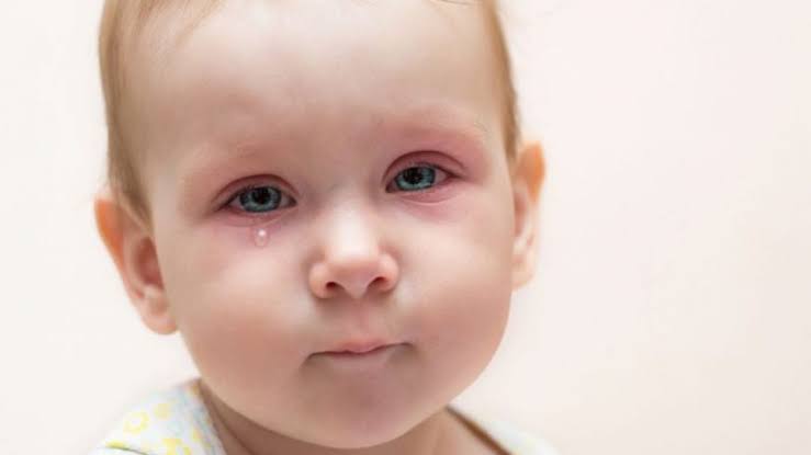 أفضل 10 علاجات منزلية لالتهابات العين في الاطفال 5