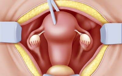 الحمل بعد استئصال الرحم 8